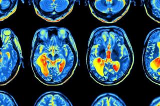 Brain imaging, courtesy of Wikimedia Commons and Creative Commons